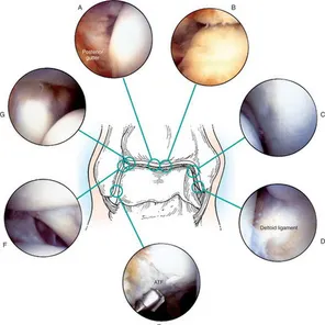 Артроскопия