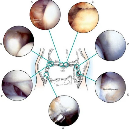Артроскопия